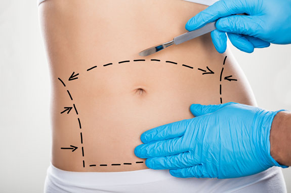 Abdominoplastik Bonn